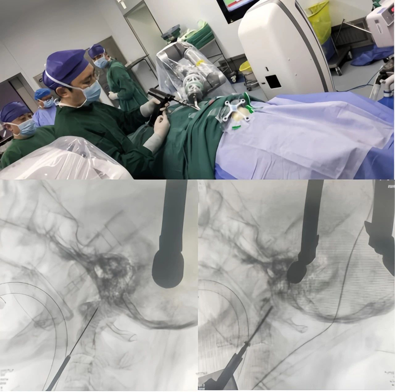 全州首例！州人民医院脊柱外科成功开展机器人辅助下枢椎齿状突骨折复位内固定术