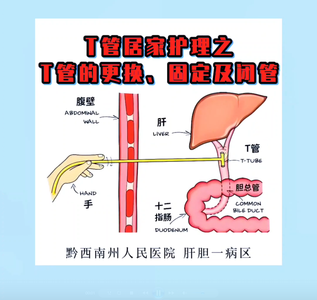 T管居家护理——T管的更换、固定及闭管